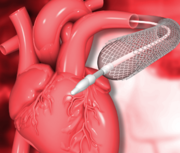 Coronary Angioplasty