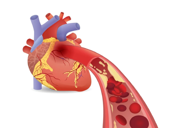 Chronic Total Occlusion 