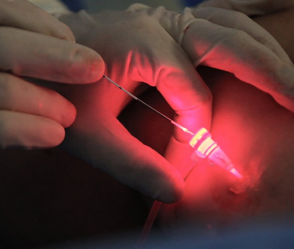 Endovenous Thermal Ablation 