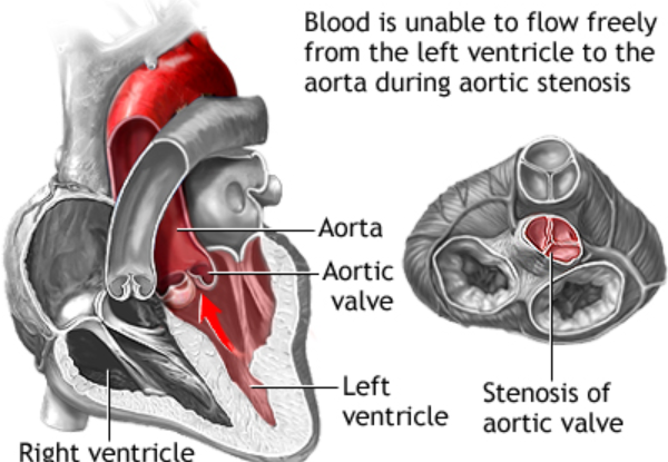 Aortic Valve Stenosis
