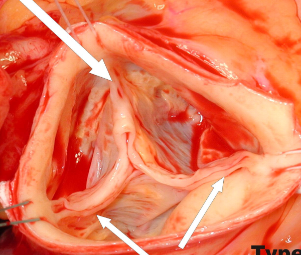 Bicuspid Aortic Valve