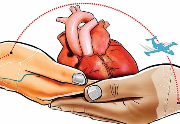 Heart Transplantation