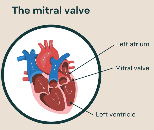 >Mitral Valve Prolapse