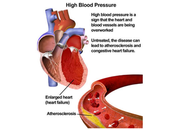 Systemic Hypertension